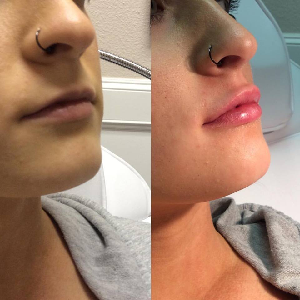 Lips Two - Aesthetics: A Gentle Alternative To Fighting The Signs Of Aging